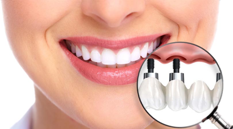 Dental Implant Treatment